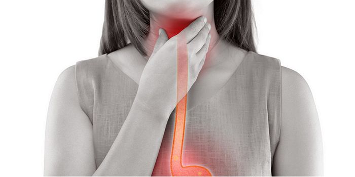 More young adults are being diagnosed with esophageal adenocarcinoma
