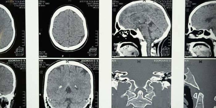 Noninvasive Focused Ultrasound Offers Pain Relief