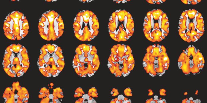 Largest Study on Early Onset Psychosis Highlights Key Brain Difference