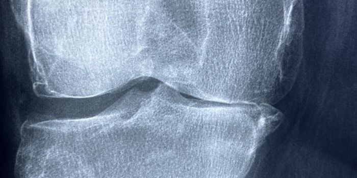 Resolvin T4 Found to Reverse Inflammation and Reduce Vascular Disease