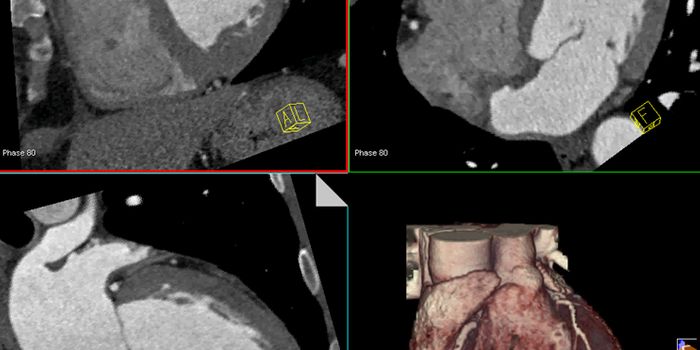 Experts Recommend Coronary Artery Disease Screening for Hodgkin's Lymphoma Survivors