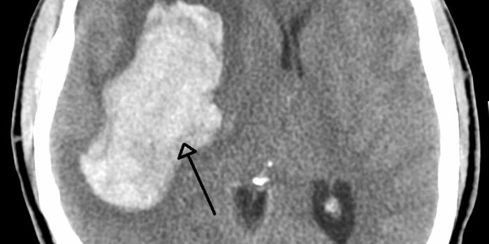 Heavy Drinking May Cause More Strokes Than Hypertension Does in Mid-Life