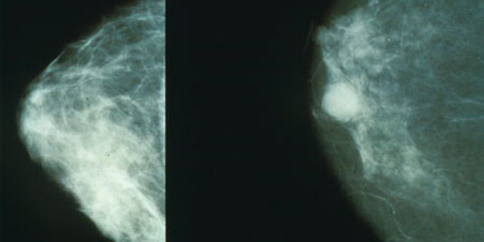 How Immune Cells Facilitate the Spread of Breast Cancer