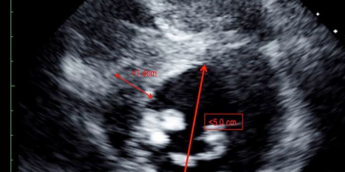 NOTCH Pathway Contributes to Aortic Valve Disease