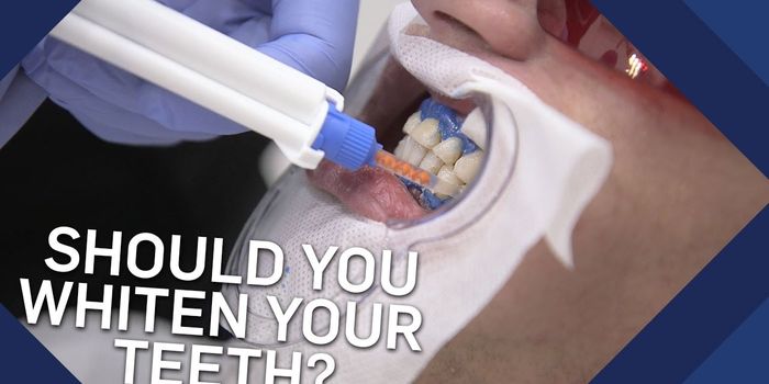 Is it Safe to Bleach Your Teeth?