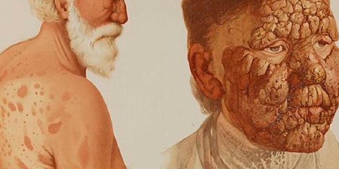 Budget Cuts Mean Less Research and Care for Leprosy Patients