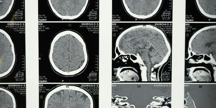 AI Tool Predicts Alzheimer's Progression with 82% Accuracy