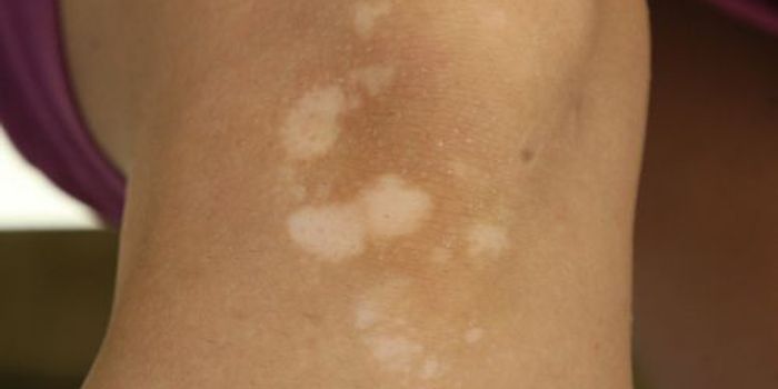Tinea Versicolor, Diagnosis And Treatment
