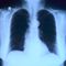 Pneumonia Found to Predict Cancer