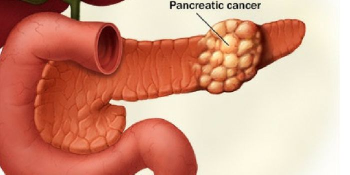 Drug Could Give Months Back to Pancreatic Cancer Patients