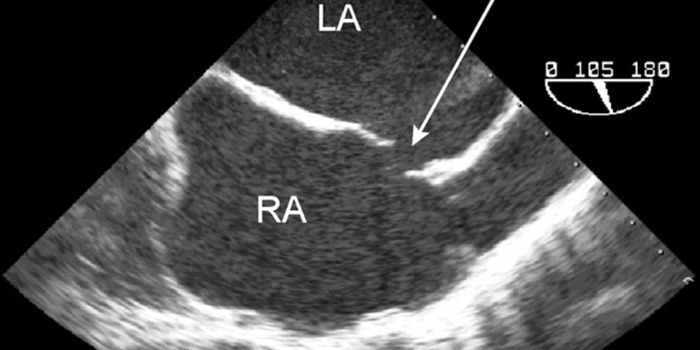 Heart Defects Result from Mutations All Over the Body