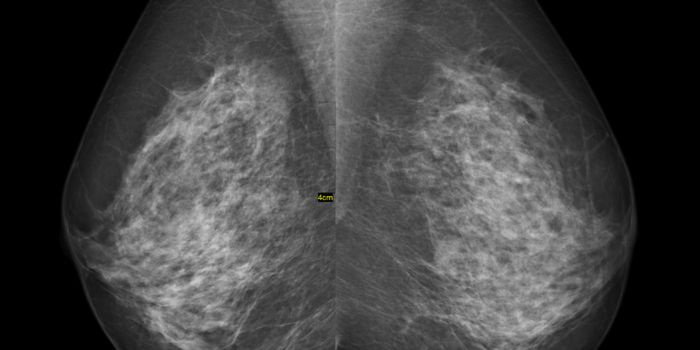 New Study Highlights Mammogram and Overdiagnosis
