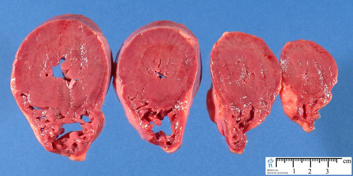 Rogue Proteins Explain Cardiac Hypertrophy