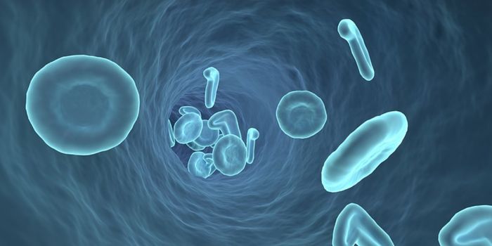 The Loss of Y Chromosomes, a Natural Part of Aging, Drives Certain Cancers