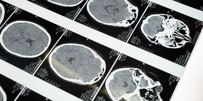 Magnetic Seeds Destroy Hard-to-Reach Brain Tumors in Mice