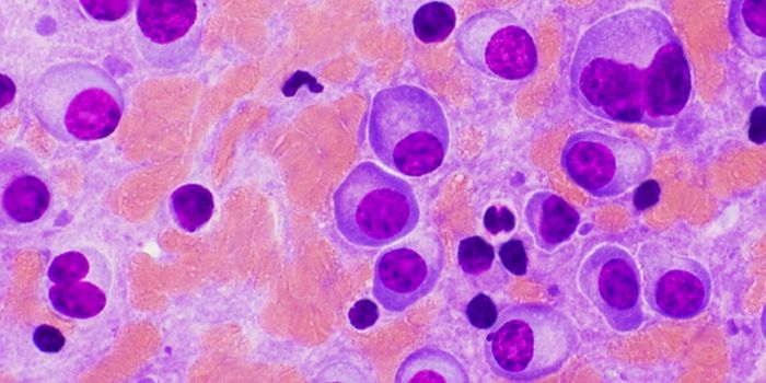 Potential Bcl-2 Targeted Therapy for Relapsed Multiple Myeloma Patients