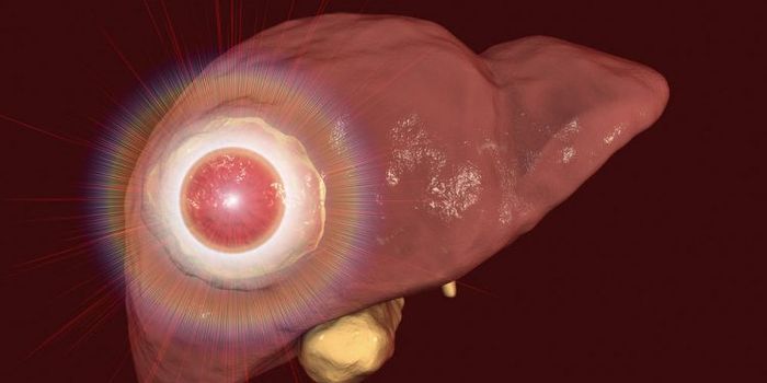 A Modified Version of Herpes Simplex Virus-1 May Cure Advanced-Stage Liver Tumors