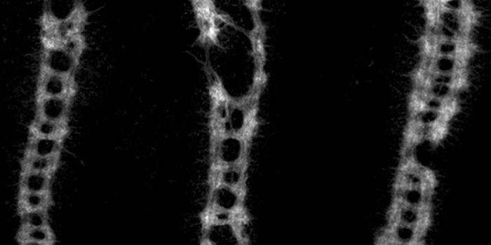 Link ID'ed Between Autism and Errors in the Creation of Large Proteins