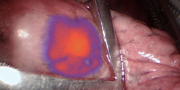 Making Tumors Glow for More Effective Removal