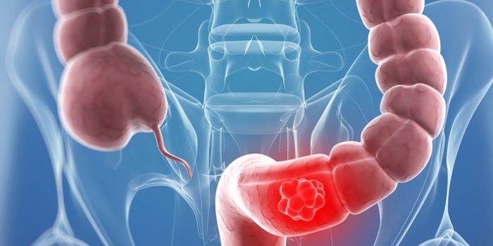 Bacterial Species Found to Promote Colorectal Cancer and Chemotherapy Resistance