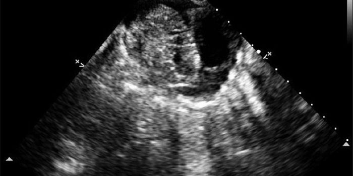 Successful Fetal Heart Surgery Removes Tumor