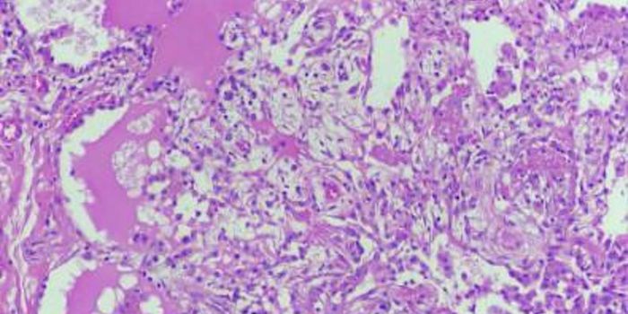 Unusual Mutation Acts as a Kind of Gene Therapy