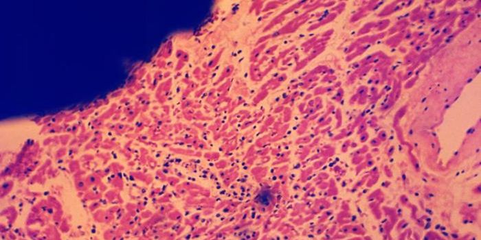 Myocarditis in Children is Usually Due to a Virus