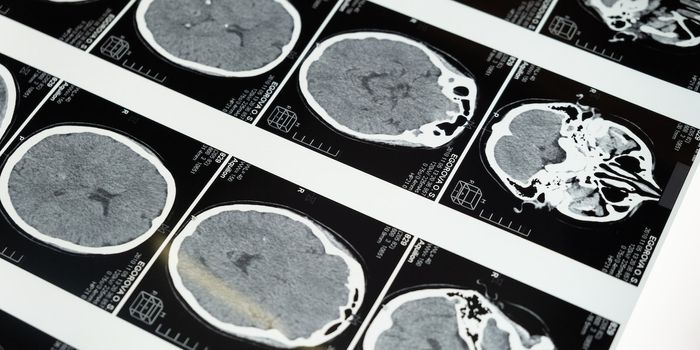 Specialized MRI Shows Post-COVID Brain Changes