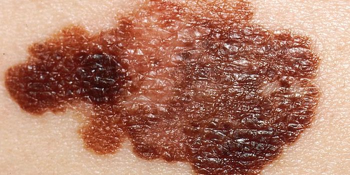 A.I. on Par With Doctors in Diagnosing Melanoma