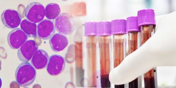 Short-Term Leukemia Success Attributed to Immunotherapy