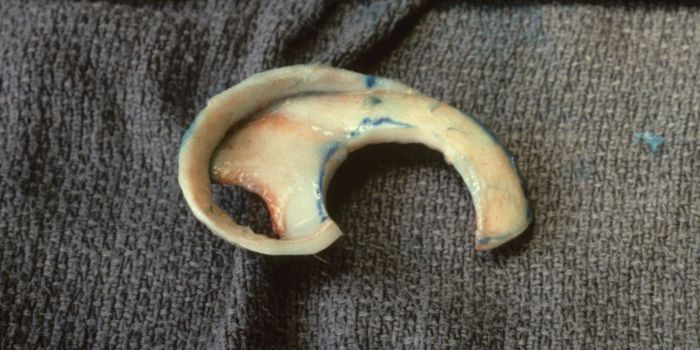 Several Children Get Newly Grown Ears