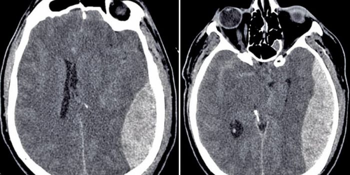 Common Therapeutic Can Treat Bleeding Associated with Traumatic Brain Injury