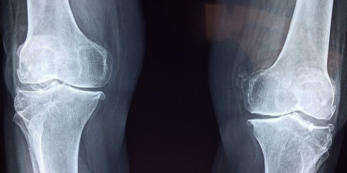 Arthritis Subtypes 'Deconstructed' by New Cellular Atlas