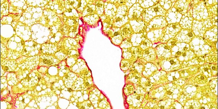 Liver Disease Discovery Resolves Controversy