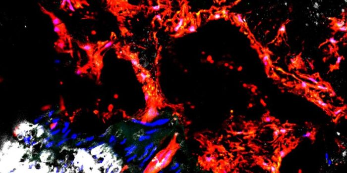 Stem Cell Causes Calcification of Blood Vessels