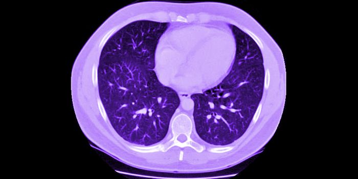 CT scans are better at spotting clogged arteries