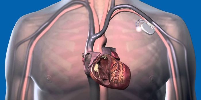Newest Therapy for Heart Failure Utilizes Asynchronous Electrical Shocks