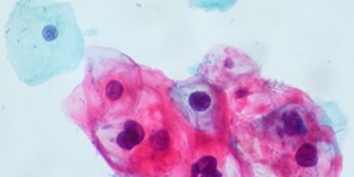 Discovery by UCLA researchers could lead to  better head and neck cancer therapies