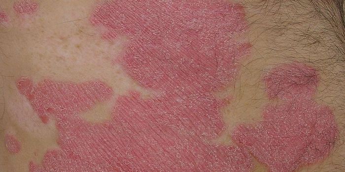New Treatment for Psoriasis and Other Autoimmune Diseases