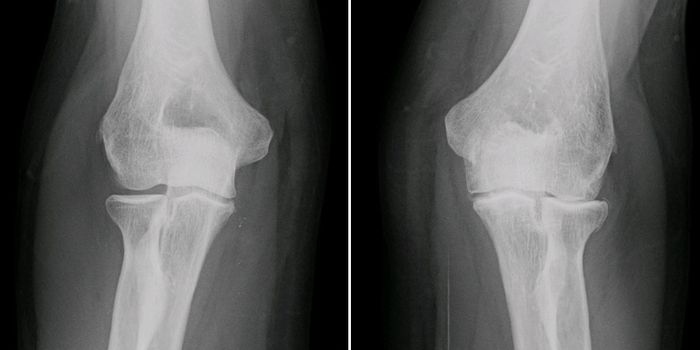High-fat, High-carb Diet can Cause Osteoarthritis