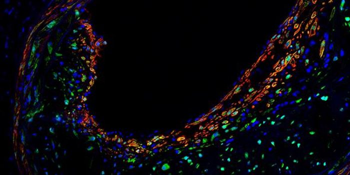Gene Prevents Heart Attack and Other Age-Related Conditions