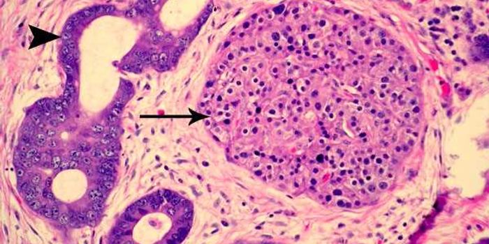 Overexpression of Certain Genes Makes a Certain Pancreatic Cancer More Lethal