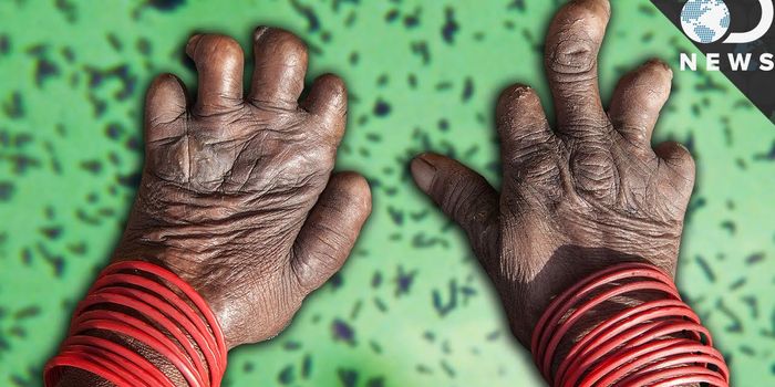 What is Leprosy?