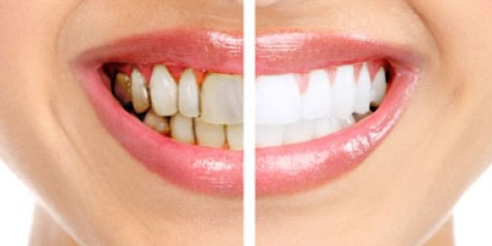 P. gingivalis, the gum disease culprit