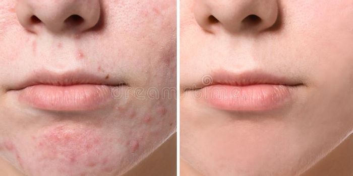 Topical Probiotics Are a Beneficial Acne Treatment