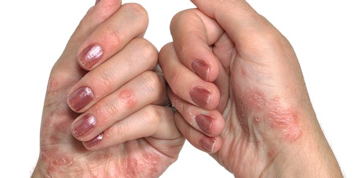 Scientists Learn More About Psoriasis Development