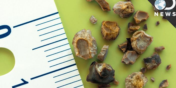 What Are Kidney Stones?