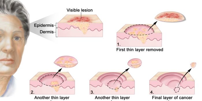 A Call to Reduce Mohs Skin Cancer Surgery: Doctors Respond to Peer Letters