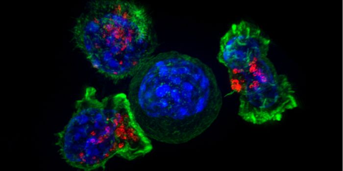 First Cancer Patient Treated with "Base-Edited" T Cells