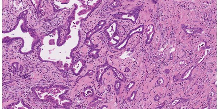 Pancreatic Cancer Cells and Their Immune Invisibility Cloak